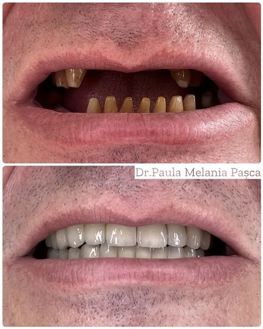 Reabilitare protetică completă — Înainte / după