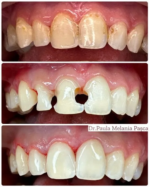 Restaurare estetică frontală — Înainte / după