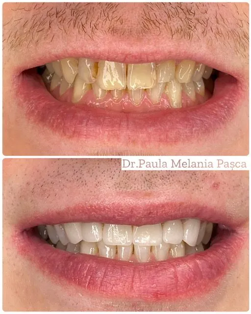 Transformare estetică a zâmbetului — Înainte / după
