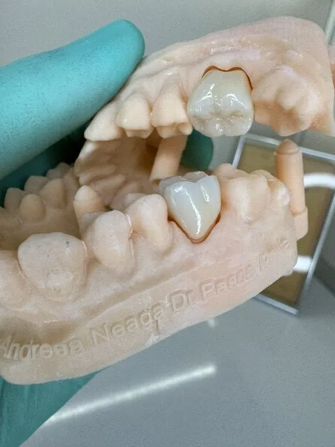 Lucrare protetică pe model